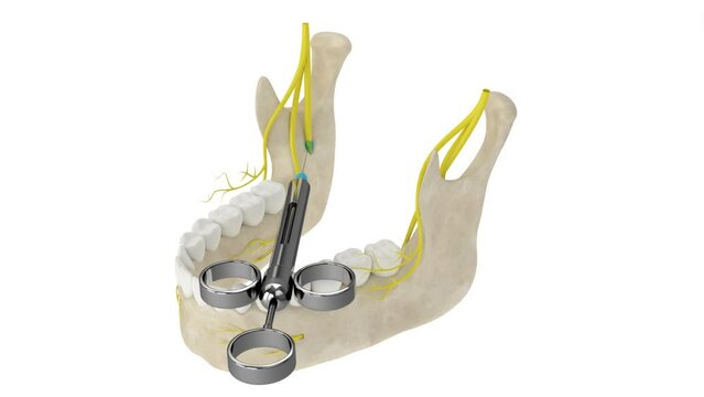 Mandibular arch with inferior alveolar nerve block. Types of dental anesthesia concept. 