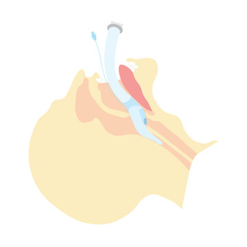 Intubation with laryngeal mask illustration. LMA positioning