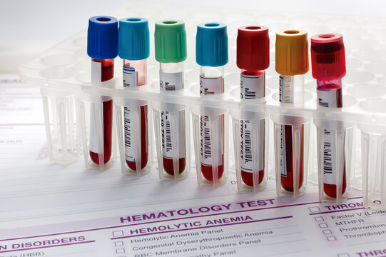 Laboratory tray with collection of blood testing sample tubes for analysis. Rack of tubes with blood samples from patients in the hematology lab