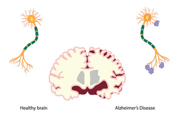 Fototapeta premium Brain divided in two showing at the left a healthy brain and neuron and in the right side a brain and a neuron affected by alzheimer's disease. 