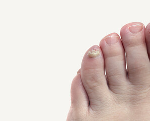 Close-up of foot with toenail fungus on white background. Nail detachment - Onycholysis