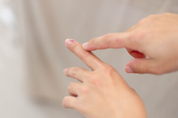 Female hand pointing to dry, cracked skin on cuticles, skin is torn and flaking off should be treated with the moisturizer for repair.