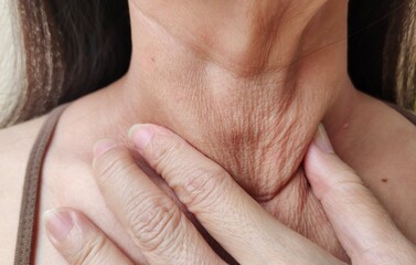 close up a hand holding the flabbiness adipose sagging skin, wattle and cellulite under the chin, problem wrinkles and flabby skin under the chin of the woman, health care and beauty concept.