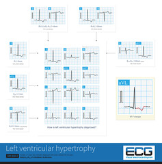 Sometimes, because the QRS axis is in the upper left quadrant, the high-amplitude R wave of left ventricular hypertrophy occurs in the limb leads, and left chest leads is normal.