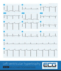 Sometimes, because the QRS axis is in the upper left quadrant, the high-amplitude R wave of left ventricular hypertrophy occurs in the limb leads, and left chest leads is normal.
