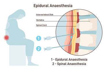 Epidural and spinal anesthesia. Labor anesthesia of pregnant woman - obrazy, fototapety, plakaty