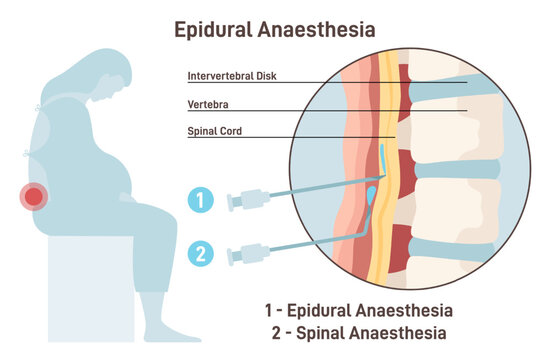 Epidural and spinal anesthesia. Labor anesthesia of pregnant woman