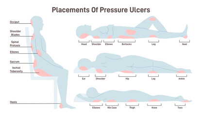 Pressure ulcers placements. Pressure sores areas on human body part - obrazy, fototapety, plakaty