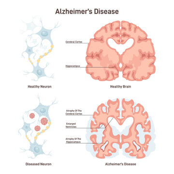 Alzheimer's disease. Human brain cross section, healthy and diseased