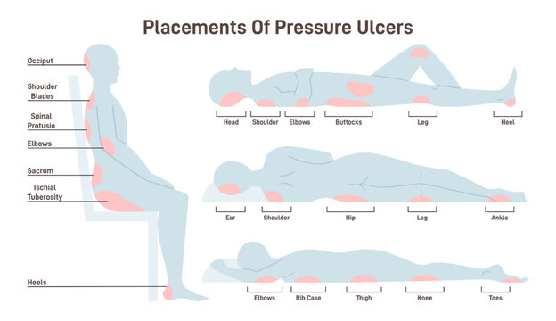 Pressure ulcers placements. Pressure sores areas on human body part