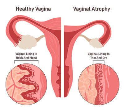 Vaginal atrophy. Thinning, drying and inflammation of the vaginal walls