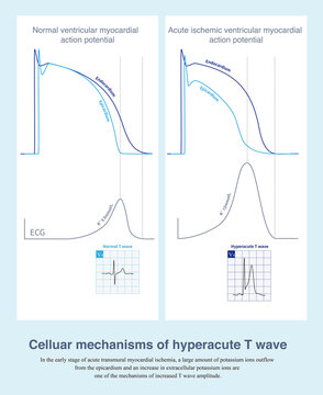 In acute transmural myocardial ischemia, epicardial potassium outflow and myocardial interstitial potassium concentration increase, which is one of the reasons for the increase of ECG T wave.