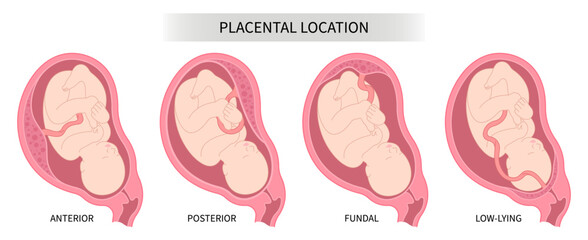Pregnancy prenatal care and uterine wall growth restriction with baby Lateral placenta location back fetus Labour death intrauterine gender prediction