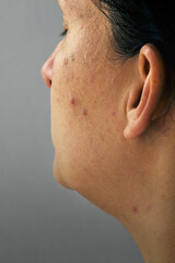 Naklejka premium Woman with problematic skin and acne, closeup