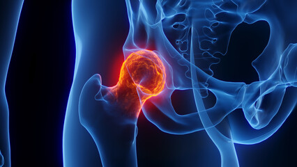 3D rendered Medical Illustration of Male Anatomy - Inflamed Hip Joint. - obrazy, fototapety, plakaty