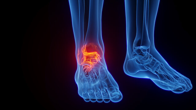 3D rendered Medical Illustration of Male Anatomy - Inflamed Ankle. Plain Black Background.