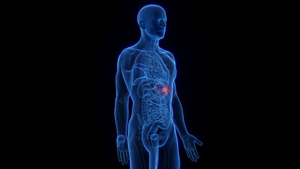 3D Rendered Medical Illustration of Male Anatomy - Splenic Cancer.