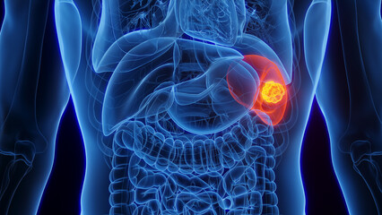 3D Rendered Medical Illustration of Male Anatomy - Splenic Cancer.