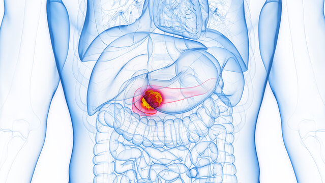 3D rendered Medical Illustration of Male Anatomy - Pancreatic Cancer.