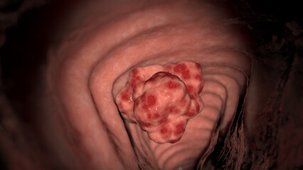 3D Rendered Medical Illustration of Colon Cancer