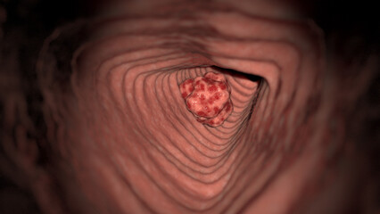 3D Rendered Medical Illustration of Colon Cancer