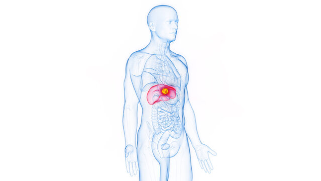 3D rendered Medical Illustration of Male Anatomy - Liver Cancer.