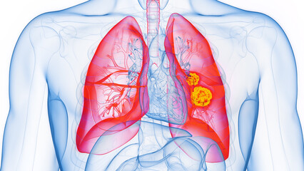 3D rendered Medical Illustration of Male Anatomy - Lung Cancer.
