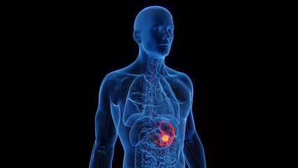 Obraz na płótnie Canvas 3D Rendered Medical Illustration of Male Anatomy - Stomach Cancer.