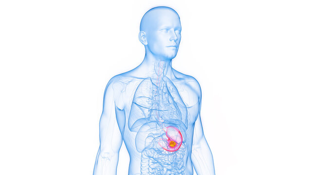 3D rendered Medical Illustration of Male Anatomy - Stomach Cancer.
