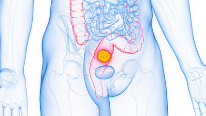 3D rendered Medical Illustration of Male Anatomy - Rectal Cancer.