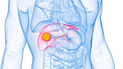 3D rendered Medical Illustration of Male Anatomy - Liver Cancer. Plain White Background. - obrazy, fototapety, plakaty