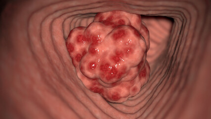 3D Rendered Medical Illustration of Colon Cancer