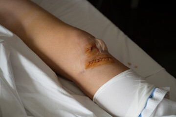 Fototapeta na wymiar Wound from a cruciate ligament and meniscus operation closed with surgical staples