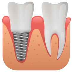 Dental implant structure, human teeth and dental implant