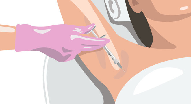 The doctor makes injections of botulinum toxin in the underarm area against hyperhidrosis. Women's cosmetology concept. illustration