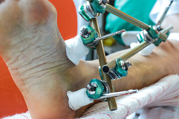 Bone fracture foot and leg on femenine patient with splint clamping mechanism post surgery and...