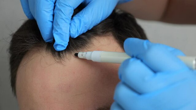 Hands of specialist in rubber gloves make marks on forehead of man on grey background. Male patient prepares for hair transplant surgery closeup