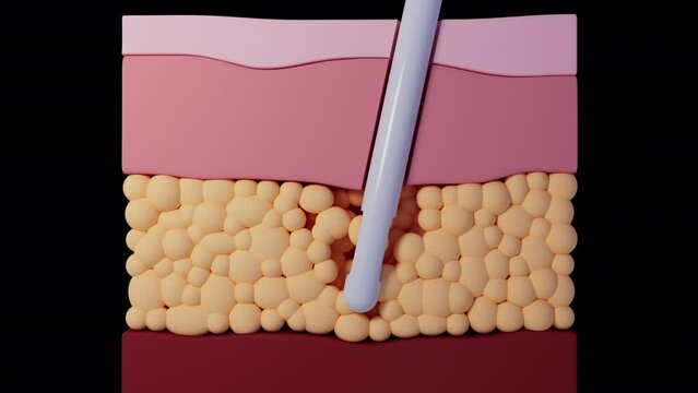 Conceptual Liposuction Treatment