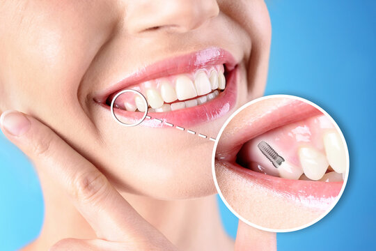 Woman with beautiful smile after dental implant installation procedure on blue background, closeup