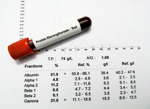 Blood sample and patient's report isolated for Protein Electrophoresis test. Close up.
