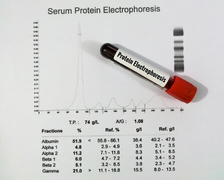 Blood sample and patient's report isolated for Protein Electrophoresis test. Close up.