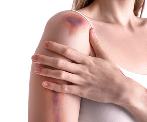 Young woman with bruised arm on white background, closeup