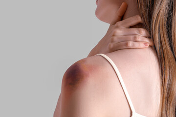 Young woman with bruised shoulder on grey background, closeup