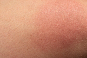 Fototapeta premium Allergy on the human body and redness from a wasp sting.