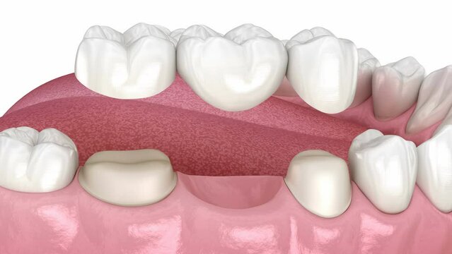 Dental bridge based on 2 teeth. Medically accurate 3D animation
