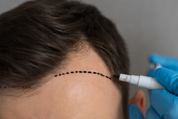 Hands of specialist in rubber gloves make marks on forehead of man on grey background. Male patient prepares for hair transplant surgery closeup - obrazy, fototapety, plakaty