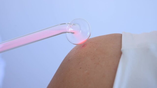The doctor uses the darsonval apparatus against acne on the shoulder of a female patient.
