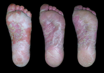 Treatment of allergic skin disease in three pictures.