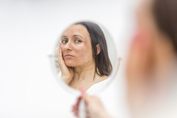 Photo of woman having skin problems looking in the mirror.