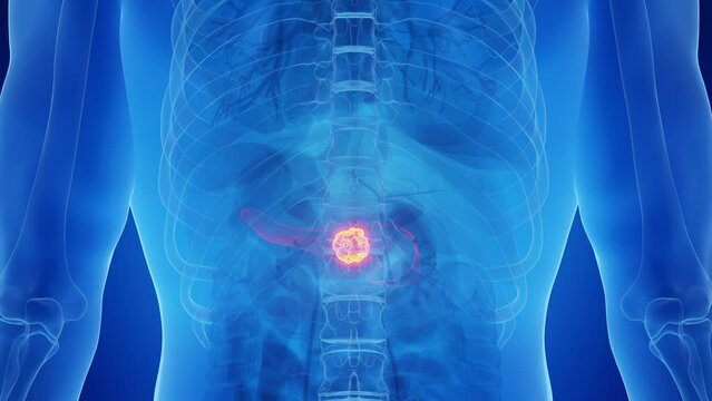 3d rendered medical animation of a malignancy in a man's pancreas